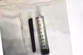 Bị đâm nửa chiếc đũa 9cm vào mũi, sau 4 năm mới hay