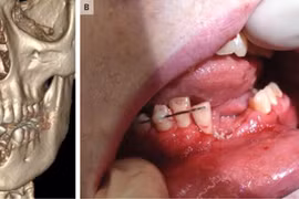 Thuốc lá điện tử phát nổ trong miệng,cậu bé bay răng, gãy đôi xương hàm
