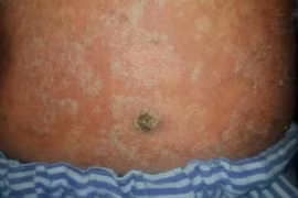 Uống thuốc gia truyền bỏ chất độc, nam thanh niên mắc ung thư