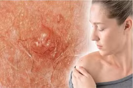 Dấu hiệu gần giống nốt ruồi cảnh báo bệnh ung thư da