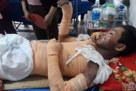 Bé trai 15 tuổi đi làm thuê bị điện giật bỏng 70% ở Đắk Lắk