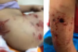 Thêm 2 bé trai bị chó dữ cắn rất thương tâm, phải nhập viện