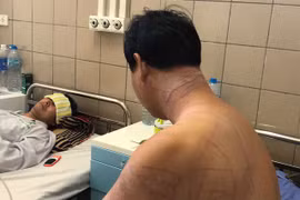 Sứa khổng lồ tấn công, du khách chằng chịt vết thương trên lưng