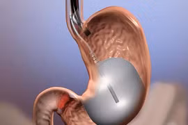 12 người chết do nuốt bóng vào bụng để giảm cân