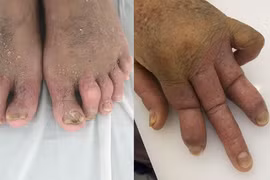 Biến dạng toàn thân do uống thuốc "thầy lang" trị vảy nến