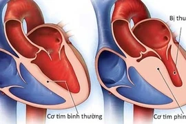 Bộ Y tế chưa ghi nhận chủng virus "mới lạ" gây viêm cơ tim