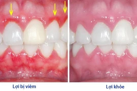 Bệnh viêm lợi và những nguy hiểm khó lường