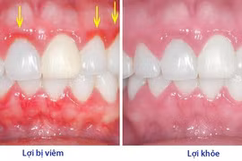 Bệnh viêm lợi và những nguy hiểm khó lường