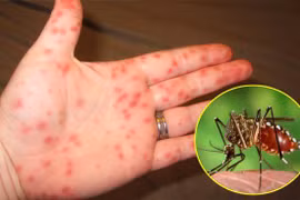 Lại thêm 1 trường hợp tử vong do sốt xuất huyết ở Đắk Lắk