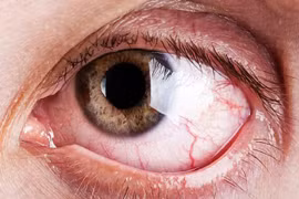 Gắp ra gần 20 con giun ký sinh từ mắt bệnh nhân