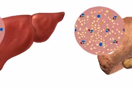 Chỉ số men gan tăng báo hiệu điều gì?