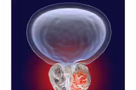 Liệu pháp hormone điều trị ung thư tuyến tiền liệt có thể tăng nguy cơ tim mạch