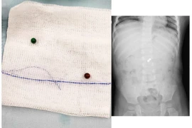 2 viên bi nam châm dính nhau trong ruột bé trai suốt 6 tháng