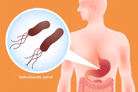 Hiểu đúng về vi khuẩn H.P để phòng ngừa biến chứng