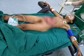 Kon Tum: Cứu sống bệnh nhân 14 tuổi gặp tai nạn lòi nội tạng ra ngoài