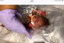 Sức sống mãnh liệt của một cậu bé sinh non