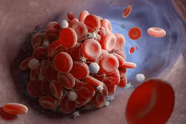 Phát hiện mới: Người mắc Covid-19 có nguy cơ phát triển các cục máu đông