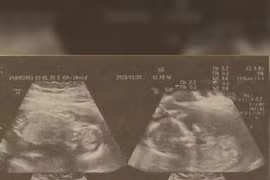 Kỳ lạ người phụ nữ mang thai 4 nhưng mới chỉ sinh 2