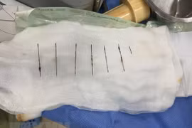 Gắp thành công 7 cây kim ra khỏi lồng ngực nữ bệnh nhân