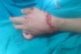 Cháu bé bị đứt rời động mạch, gân do tai nạn trong trường học