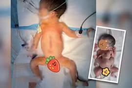 Tách bào thai ký sinh khỏi bé trai sinh ra với 4 tay, 4 chân