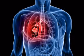 Vì sao mỗi năm thế giới có 250 ngàn người chết do bệnh ung thư phổi dù không hút thuốc?