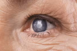 Thấy những dấu hiệu này, đi khám đục thủy tinh thể ngay!