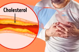 6 dấu hiệu nguy hiểm của tắc động mạch chủ dễ bị bỏ qua