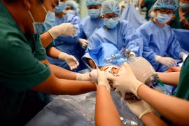 Phẫu thuật tách 2 bé gái song sinh: "Song Nhi" đã tỉnh sau ca mổ dài