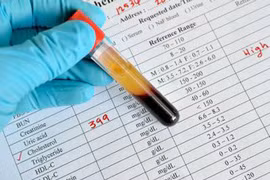 Phát hiện mới: Chất đường bột là thủ phạm chính gây ra mỡ máu