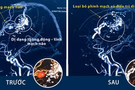 Đột ngột đau đầu dữ dội, coi chừng đột quỵ, xuất huyết màng não