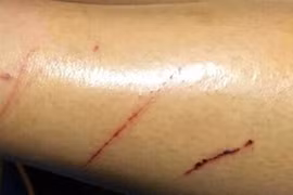 Điều tra vụ nữ sinh ở quận 12 bị kẻ xấu rạch đùi