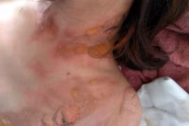 Nạn nhân tự phóng hỏa nhằm tạo hiện trường giả bị cướp