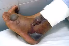 Bị cắt chân vì tin thầy lang chữa rắn cắn hơn bệnh viện