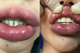 Mê thành mỹ nhân, môi cô gái sưng to như quả chuối