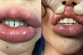 Mê thành mỹ nhân, môi cô gái sưng to như quả chuối