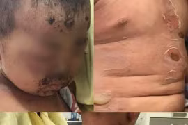 Bé trai đau đớn gào thét sau khi tắm nước lá chữa ngứa