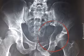 Hiếm gặp: U mọc từ háng xuyên vào ổ bụng chàng trai