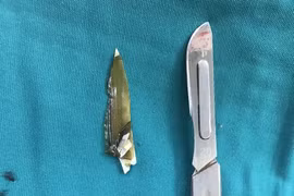 Sáng ăn bánh canh ốc 'móng tay', trưa thủng ruột