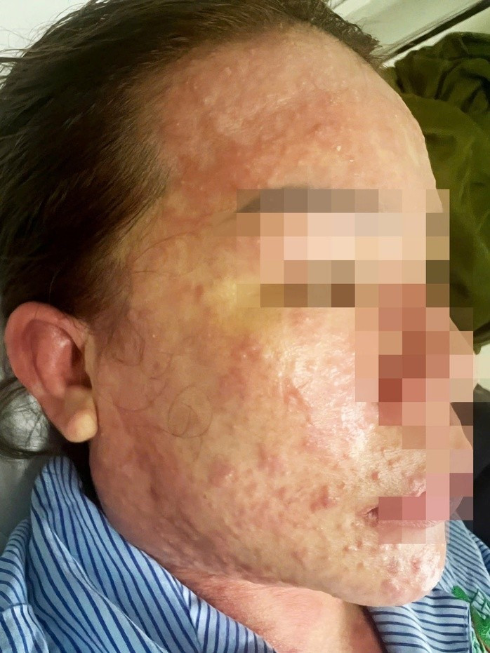Bệnh nhân nhập viện trong tình trạng da nổi ban đỏ lan rộng, kèm theo các nốt mụn nước, mụn mủ và cảm giác đau rát khắp người. Bệnh nhân nhập viện trong tình trạng da nổi ban đỏ lan rộng, kèm theo các nốt mụn nước, mụn mủ và cảm giác đau rát khắp người.