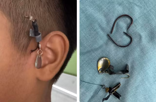 Bé trai nhập viện cùng chiếc móc câu cắm sâu vào phía trước tai trái