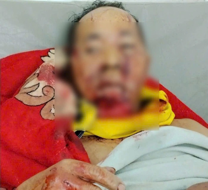 Ông Pơloong Nhương bị gấu rừng tấn công thương tích nặng (Ảnh: CTV)