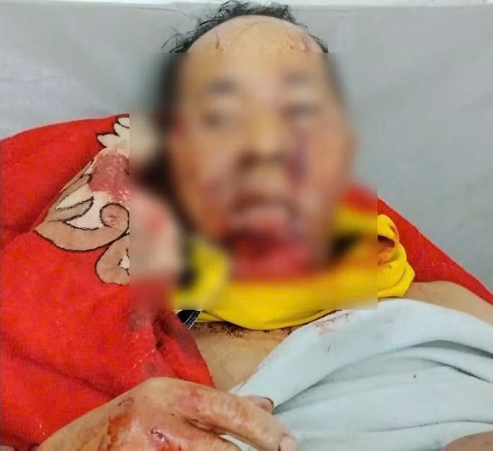 Ông Pơloong Nhương bị gấu rừng tấn công thương tích nặng (Ảnh: CTV)