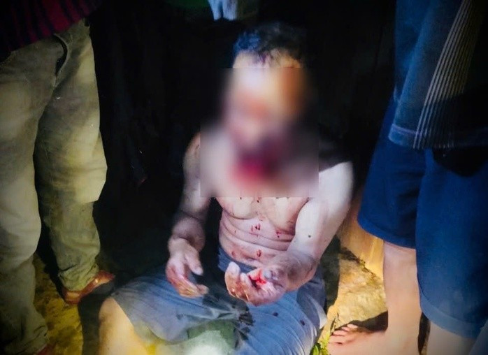 Ông Pơloong Nhương bị gấu rừng tấn công thương tích nặng (Ảnh: CTV)