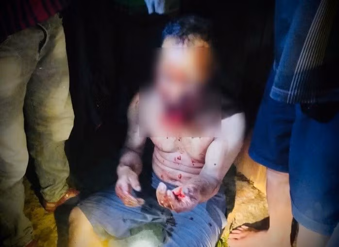 Ông Pơloong Nhương bị gấu rừng tấn công thương tích nặng (Ảnh: CTV)