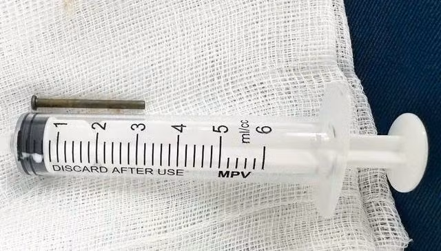 Cây đinh dài 3 cm được các bác sĩ Bệnh viện Sản - nhi tỉnh Quảng Ngãi lấy ra từ tá tràng bé trai 6 tuổi. ẢNH: K.NY