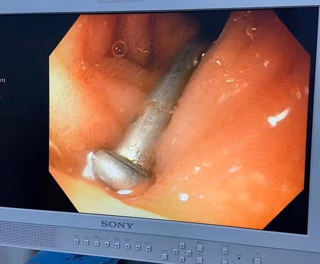 Dị vật nằm trong đường tiêu hóa của bé trai 6 tuổi. ẢNH: K.NY