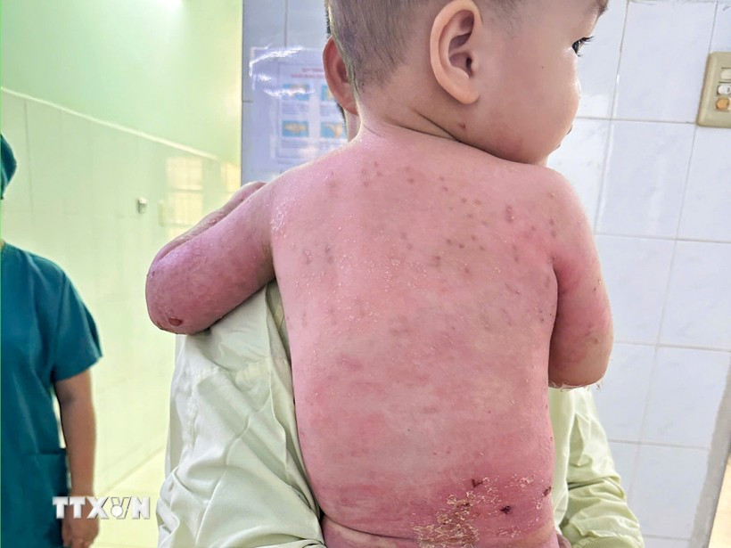 Thời điểm xuất viện, toàn bộ da bị bỏng nặng trước đây đã phục hồi hoàn toàn. (Ảnh: TTXVN phát) be-trai-2-tuoi.jpg