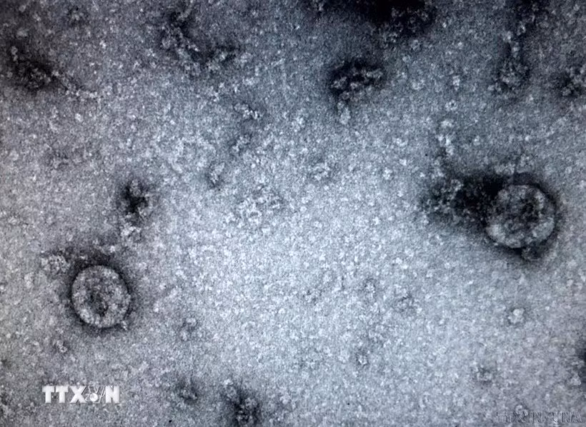 Các nhà nghiên cứu từ Đại học Y khoa Sechenov của Nga cảnh báo những người từng bị nhiễm virus SARS-CoV-2 đều có thể mắc một căn bệnh nguy hiểm: hoại tử xương. (Ảnh: TTXVN phát)