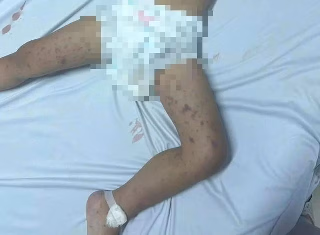 Ghi nhận trường hợp tử vong do viêm não mô cầu ở Đắk Lắk